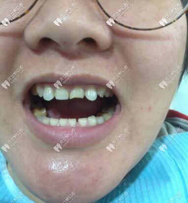 門牙磕斷了必須根管治療嗎?她還做了瓷貼面呢，超贊