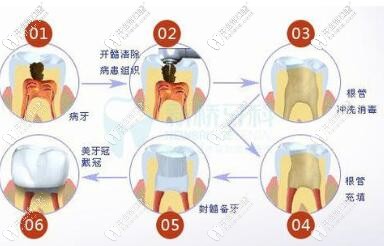 根管治療