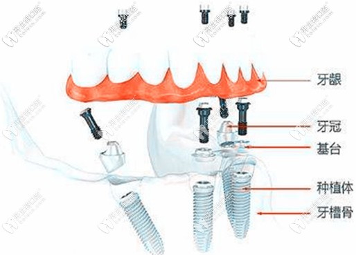 做種植牙的安裝步驟