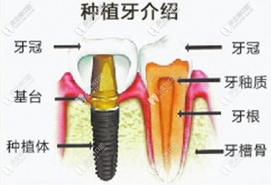 中山香山口腔醫(yī)院復(fù)活節(jié)種牙活動