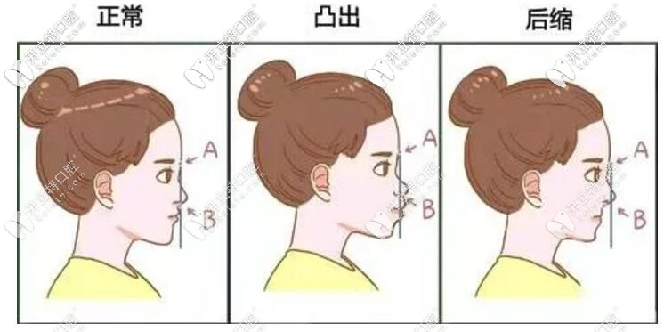 牙齒畸形影響臉型