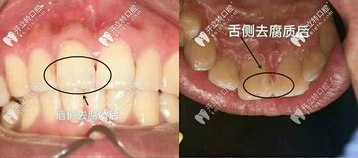 去腐質后的舌唇側