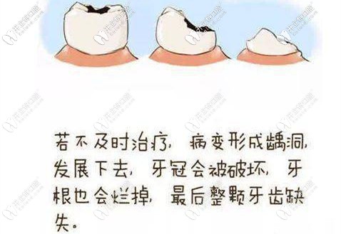 若不及時治療就會發(fā)展成重度齲齒