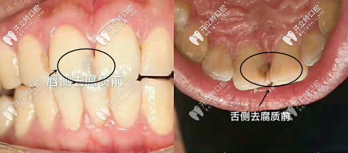 唇舌側去腐質前的照片