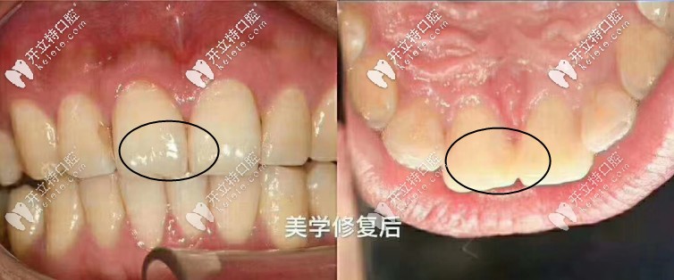 二氧化鋯全瓷嵌體修復一年后的效果