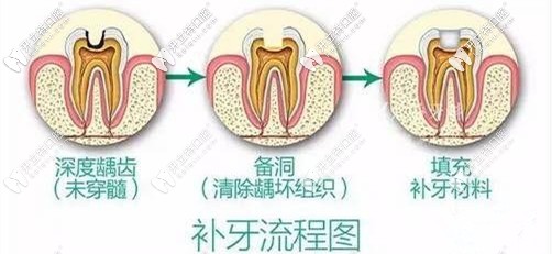 你們要的補牙流程圖來咯