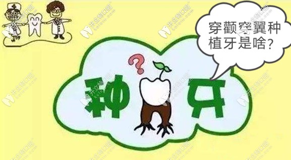 詳解高難度穿顴穿翼板種植技術(shù)