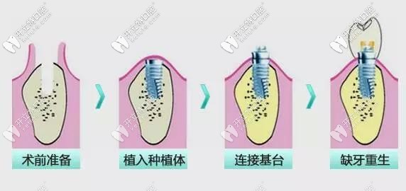 種植牙過(guò)程