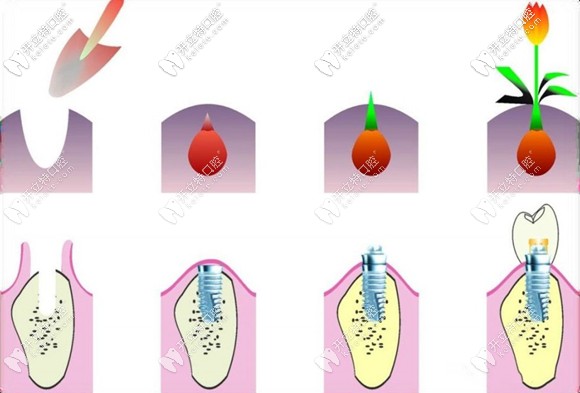 深度剖析:西班牙種植牙市場(chǎng)排行前五的品牌-mg ticare種植體