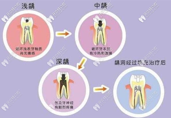 齲齒的發(fā)展過(guò)程