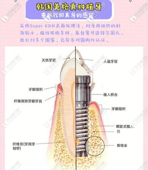 深圳河山口腔韓國美格真進(jìn)口種植牙特點(diǎn)