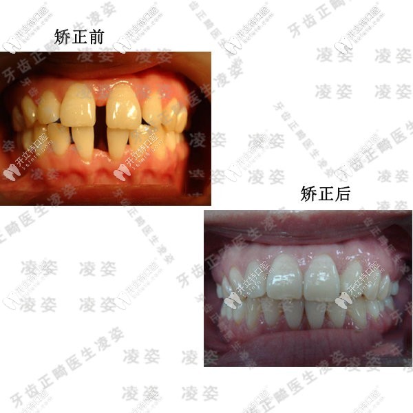 牙縫過大矯正前后效果圖 牙縫過大矯正前后效果圖