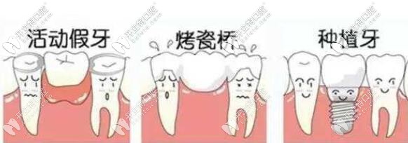 缺牙三種修復方式比較