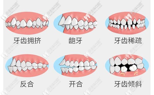 牙齒矯正適應癥
