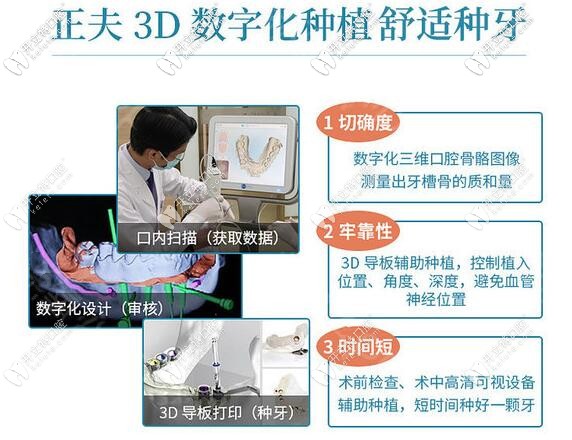 深圳正夫口腔數(shù)字化3D導(dǎo)板種植牙