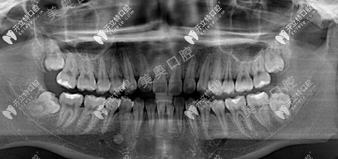 18歲牙齒矯正前X線片圖片