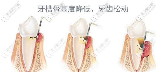 牙周炎會導致牙齒松動