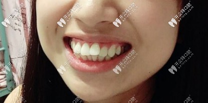 骨性+牙性齙牙，咬合有問題