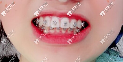 剛粘上托槽時拍的自拍照