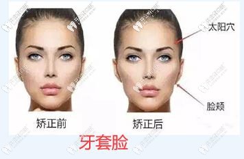 牙套臉