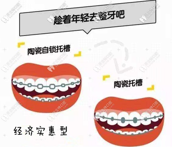 經(jīng)濟實惠型—陶瓷自鎖托槽