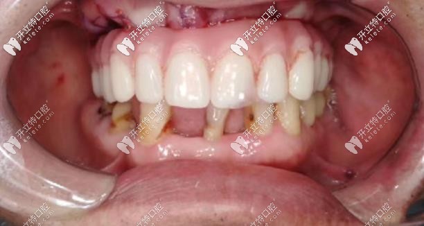 種植牙術(shù)后正面照