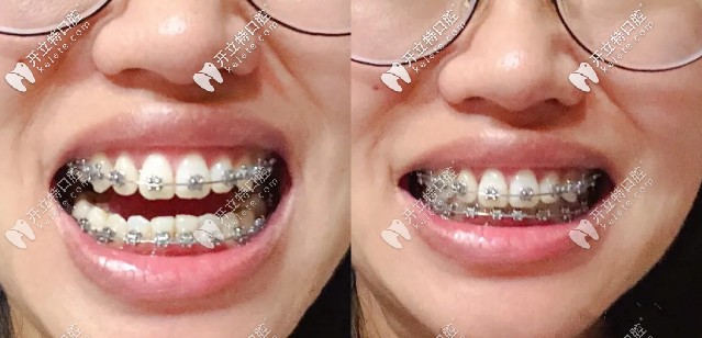 矯正后期效果對(duì)比圖