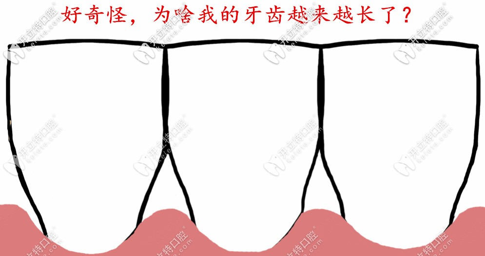 醫(yī)生，為什么我感覺牙齒越來越長了？