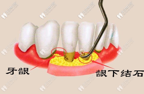 為什么牙結(jié)石會長到牙齦里面？齦下牙結(jié)石怎么處理？
