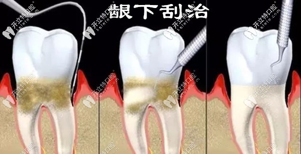 齦下牙結(jié)石怎么治療