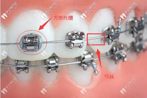 金屬托槽矯正器結(jié)構