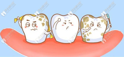 氟斑牙做完后效果真的不錯