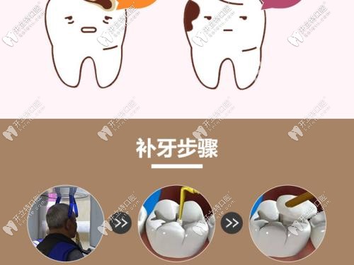 樹脂補(bǔ)牙優(yōu)惠