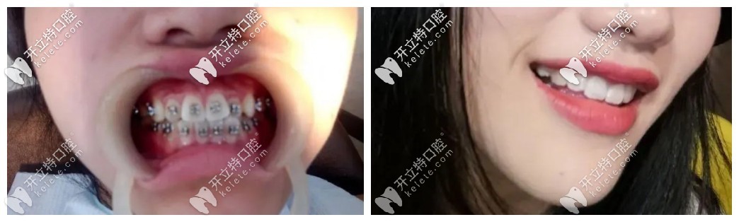 門牙有點(diǎn)外凸可以做國產(chǎn)普特第五代自鎖托槽來矯正哦