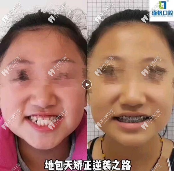 今天曬出:姑娘12歲做地包天牙齒矯正的前后對比照片
