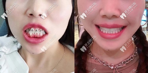 拆除牙套后，喜提一口大白牙