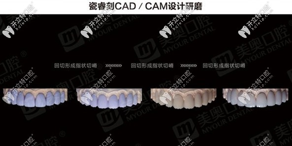 瓷?？藽AD/CAM設(shè)計(jì)