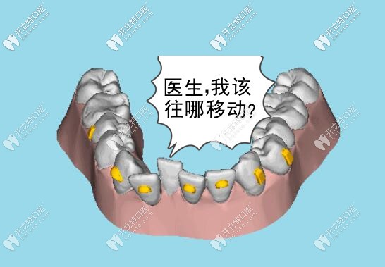 牙齒矯正時移動軌跡