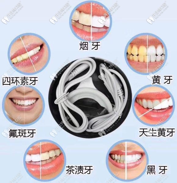 牙齒有這些情況都可以通過(guò)美白來(lái)改善
