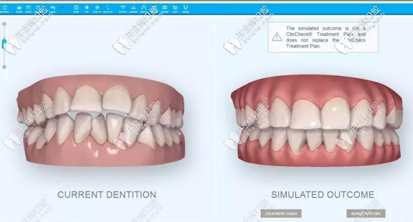 隱適美iTero口掃儀呈現(xiàn)的矯正效果圖
