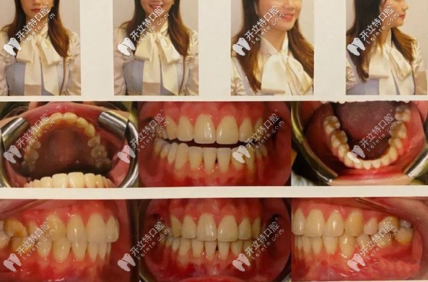 整牙的時間不長，但是<span style=