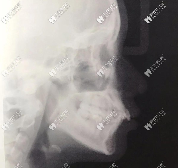 側(cè)面X光，門牙唇傾很厲害的