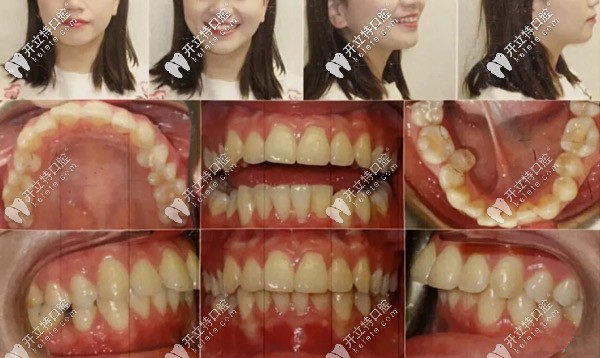 正面、側(cè)面照，記錄牙齒的變化情況