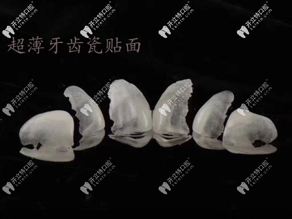 西安雁塔區(qū)牙科分享:超薄瓷貼面改善滿口黃牙的真實案例