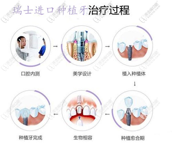 瑞士進(jìn)口種植牙治療過(guò)程