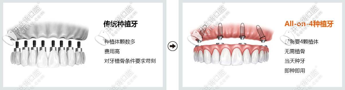 all-on-4種植牙和傳統(tǒng)種植技術(shù)