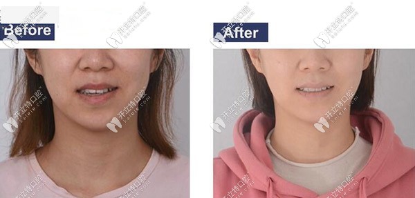 前牙開頜用時(shí)代天使隱形矯正兩年,對(duì)容貌的影響還是有的