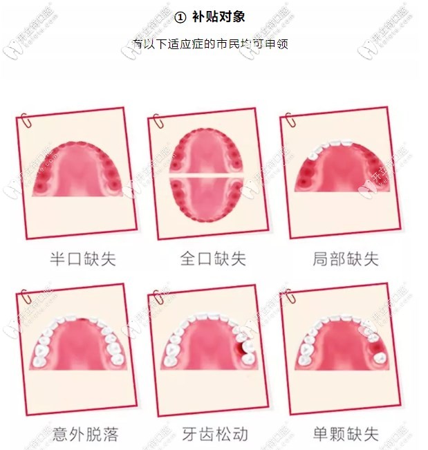 在惠州致美口腔做全口種植牙可享受到補貼3000-8000元