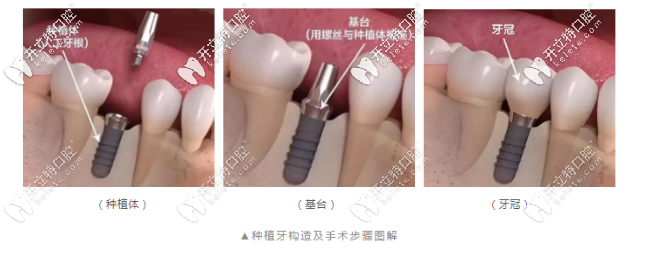 瑞典諾貝爾種植體結構