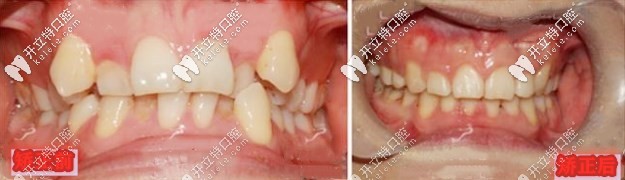 矯正前后對比